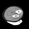 SPORK, NICO - 22.03.1976 - 02.08.2022 - CT obere Extremität - 17:56:57